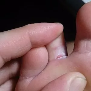 Kako liječiti gljivice na nogama djeteta kod kuće?