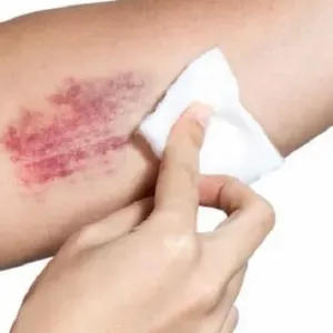 Teška modrica: kako liječiti kod kuće narodnim lijekovima